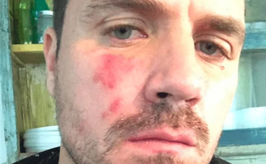 Dani Martín ha compartido con sus fans su problema de rosácea